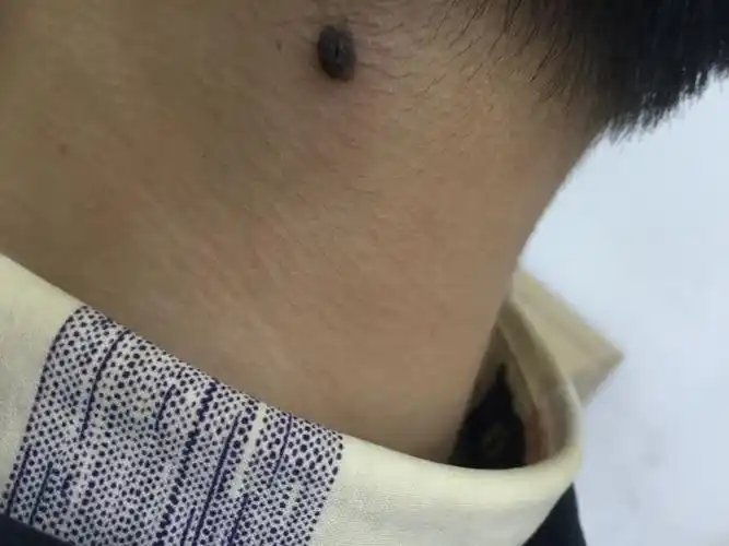后颈有颗痣变大变硬了,按下去有点疼,要不要紧,看到网上说的很恐怖