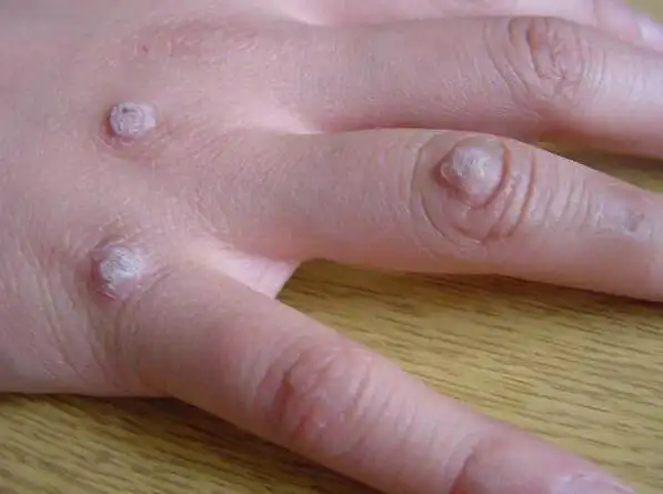 手上长瘊子 (60)