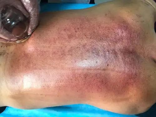 腰背部肌筋膜炎推罐治疗