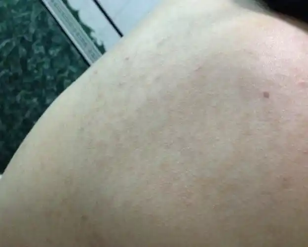 我几个月前突然背后长东西,像斑点一样褐色的,不痛