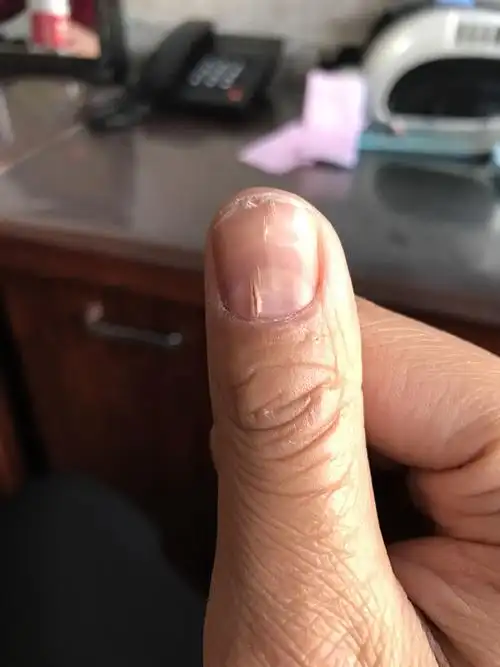 指甲根部裂缝,前部分鼓起,指甲变型.怎么治疗?