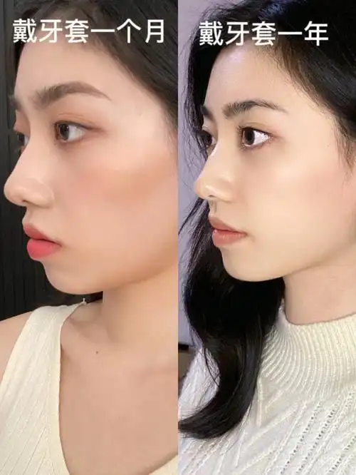 牙套给我带来的变化