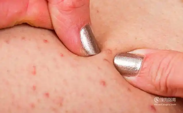 01毛囊炎多见于成年人,自觉瘙痒或有轻度疼痛,一般没有全身症状.