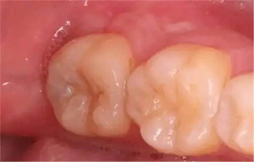 【病例分享】下颌第二磨牙根管治疗术后"印章法"树脂充填1例