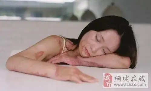 【女孩5年前遭同学泼油点火 如今勇敢拍写真】