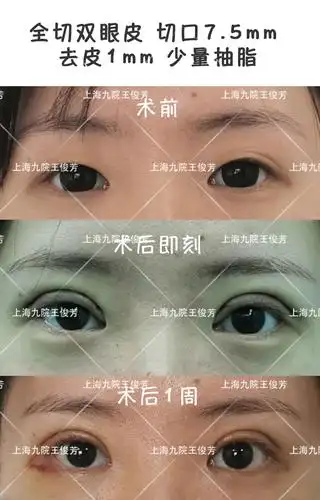 【全切双眼皮(切口7.5mm )去皮1mm 少量抽脂】案例分享 - 好大夫在线