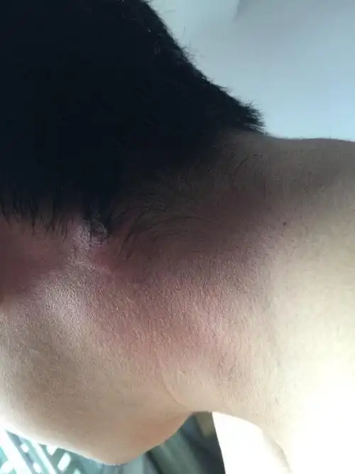 火疖子有十多天了,应为刚开始长的时候用手挤压,造成了感染,化脓严