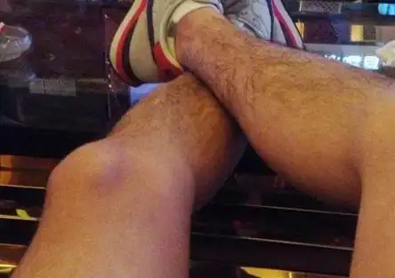 腿毛少意味着什么?|性激素|体毛|性能力_网易订阅