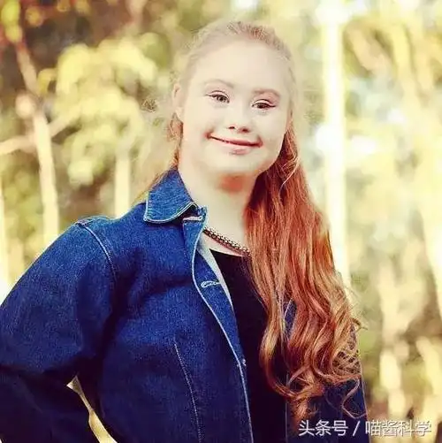 唐氏患者的基因组唐氏患者基因组最大的特征是21号染色体比正常人类多