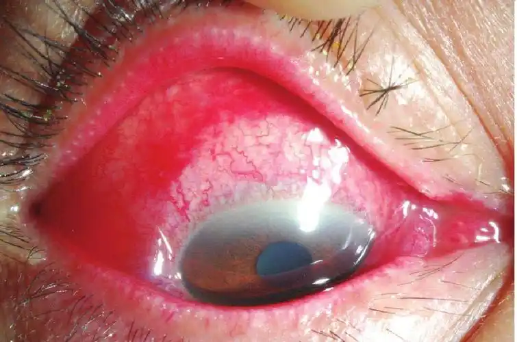 流行性出血性结膜炎