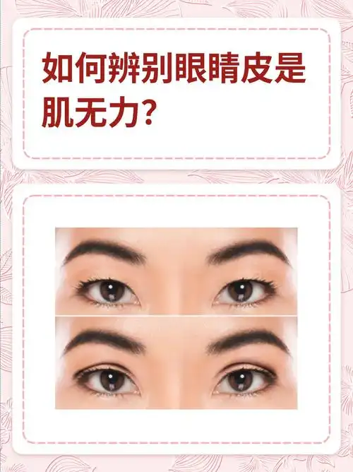 如何辨别眼睛皮是肌无力