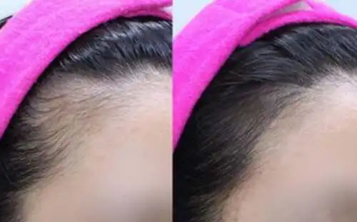 发际线种植前后对比