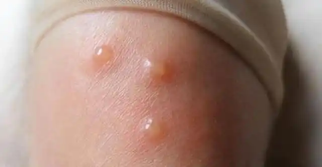 身上会出现一些红色的小疹子,还伴随瘙痒的情况,这种就被称之为湿疹