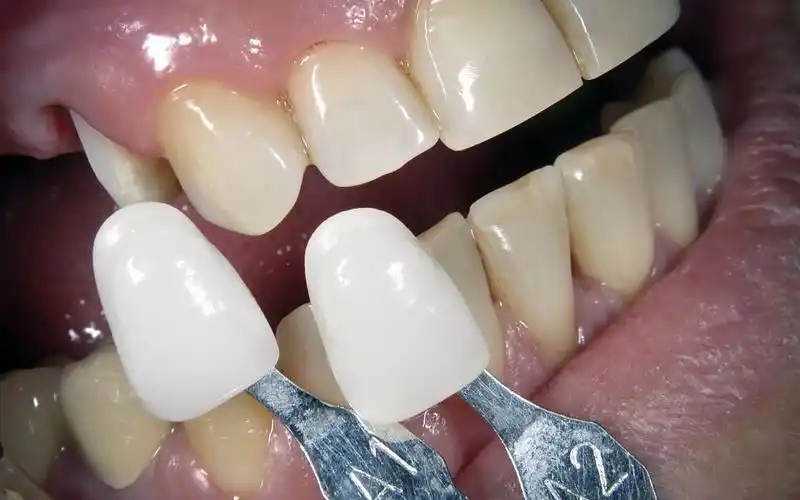 牙齿美白中的牙贴面有什么优势?哪些人比较适合做牙齿贴面?