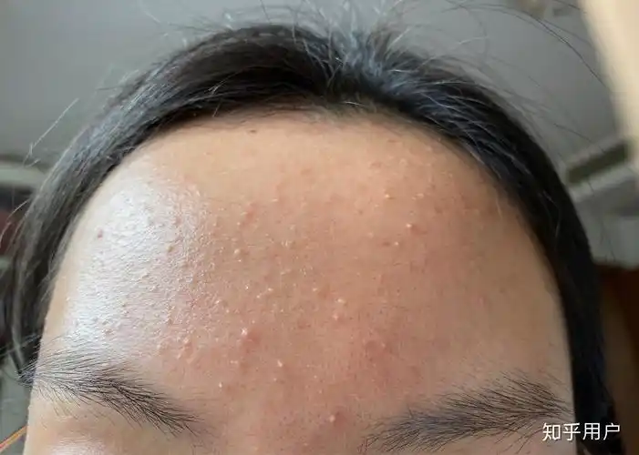 以前脸干净的要命 突然在额头上长闭口很多很多怎么办? - 知乎