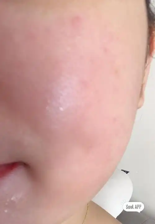 一年都是反反复复过敏,所有的护肤品都过敏,妆都不敢画了,为这个