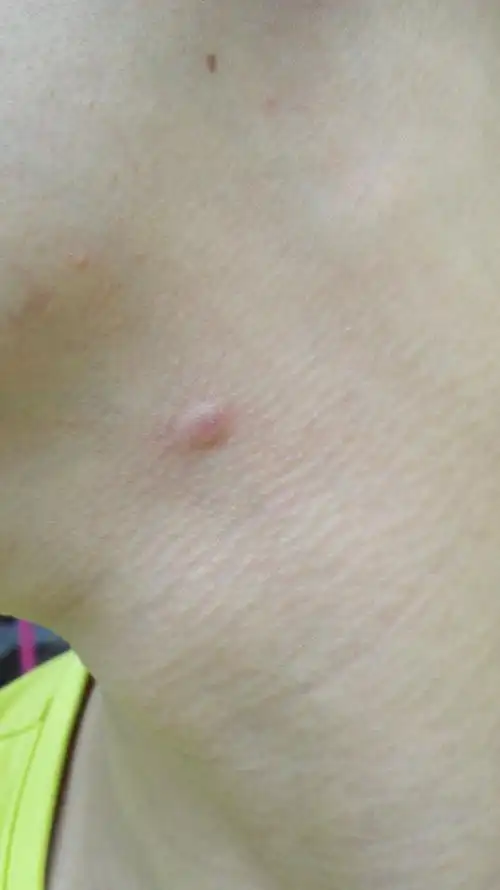 脖子长了个东西,刚开始以为是青春痘,慢慢就成这样子,捏着里面像绿