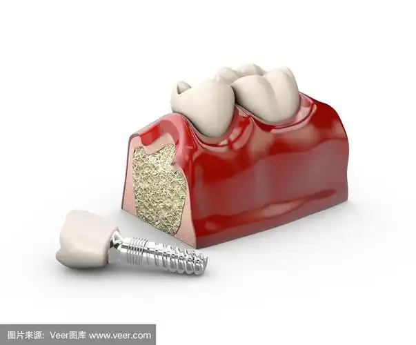 牙齿种植体模型的3d插图