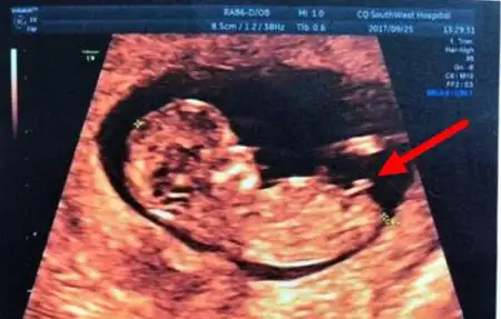 12周nt男宝特点nt值是什么nub点看男女准不准