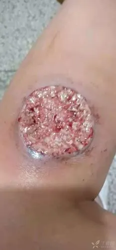 下肢反复溃烂 - 皮肤与性传播疾病讨论版 -丁香园论坛