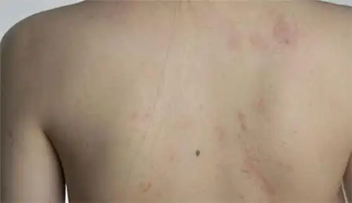 艾滋病水泡特点图片