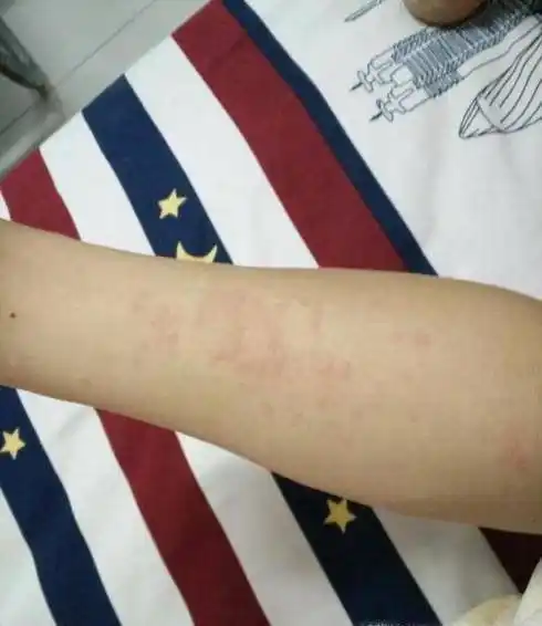 怎样测试化妆品过敏