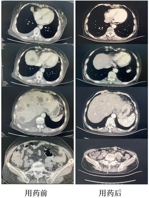 肺部ct复查结果显示:双肺多发微小结节,部分磨玻璃密度,细支气管炎,支