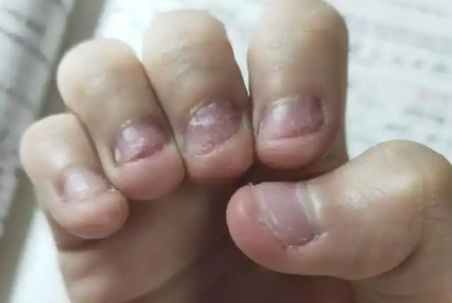 孩子总是爱"咬指甲",怎么说都改不了?长大后的三种结局很残酷