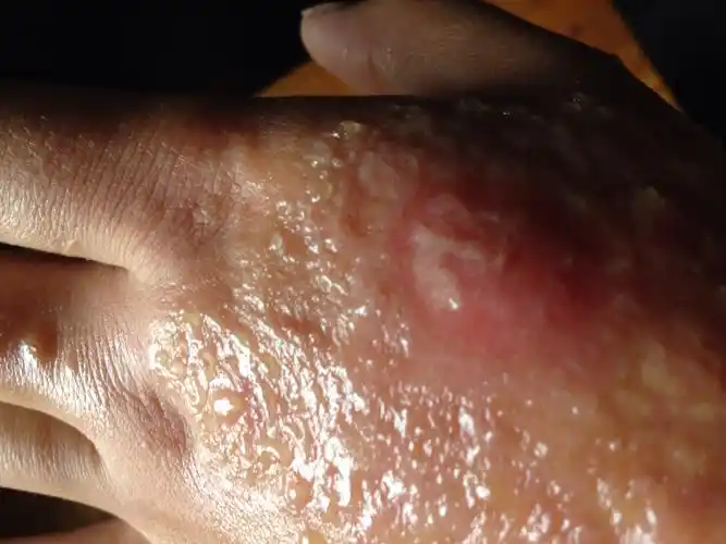 用过红霉素软膏和美宝湿润烧伤膏