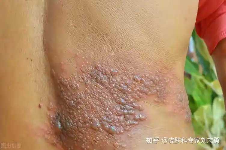 带状疱疹是由一种叫 "水痘-带状疱疹"的病毒感染引起,症状在皮肤上,但