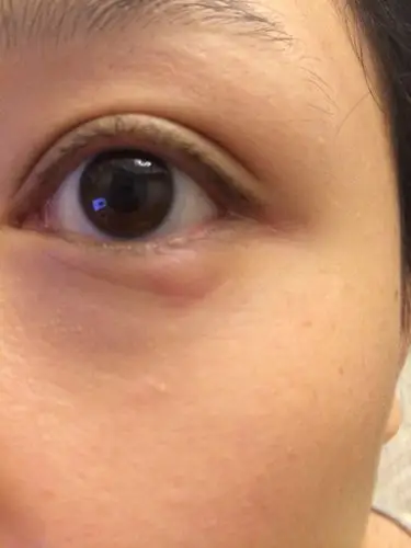 请问眼睛是怎么了 看图.下眼睑长小包,偶尔长 过一小时左右又会消.