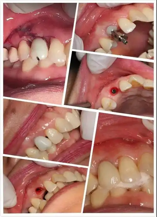 《走进民营-快速开展种植牙》零基础种植 ,口腔培训,康强培训网