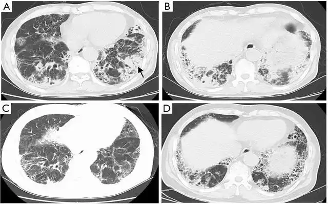qims之窗 (014): 活动性肺结核的几种不典型ct表现及机制