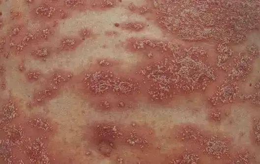 点滴型银屑病的消退期症状图片