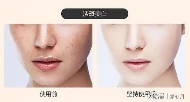跟之前对比,明显斑点少了很多,并且黑色素也减少了,想要美白祛斑的友