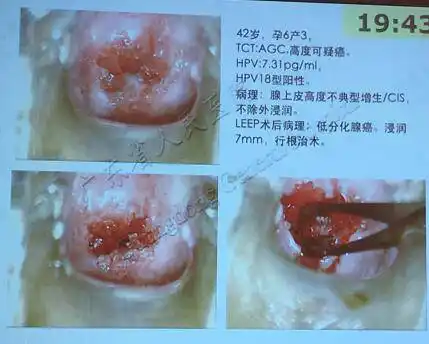 宫颈腺癌早期诊断不容忽视