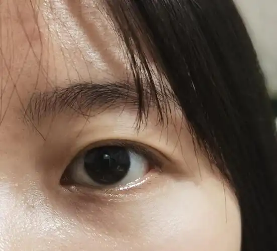 上眼皮松弛怎么办