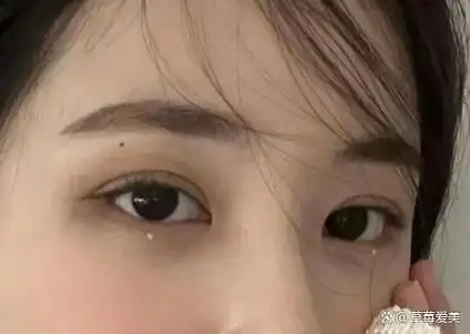 恢复到自然双眼皮宽度,7毫米双眼皮宽度大约为一毫米或者是会更少一些