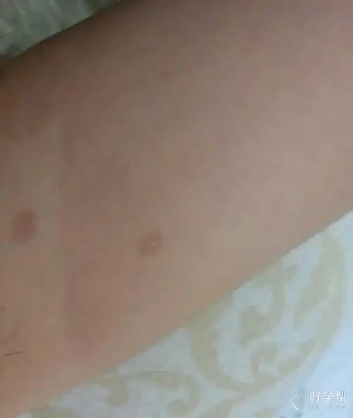 医生帮忙看看我腋下长的这小圆印是什么