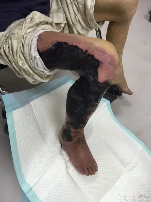 【讨论】右下肢皮肤感染坏死3个月