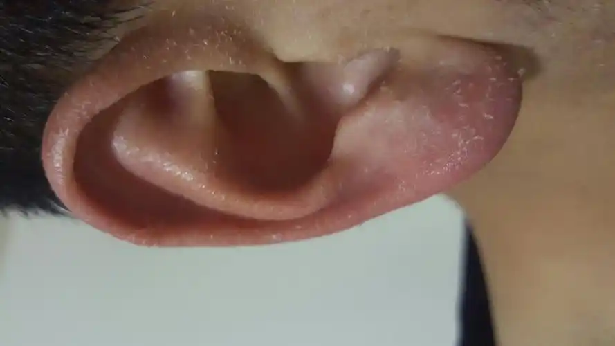 耳朵起皮,尤其是洗完头或洗澡一干就起皮,不痛不痒,以前还不这样的