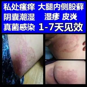 阴囊湿疹皮炎平股体藓潮湿私处治疗皮肤瘙痒外用真菌感染止痒药膏