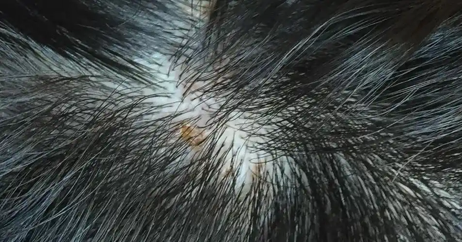 头皮上很多伤口,伴有瘙痒疼痛!是皮炎还是毛囊炎啊?求助