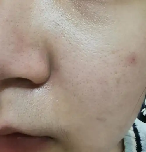 毛孔无敌大怎么改善啊啊(慎入)(轻敏皮)