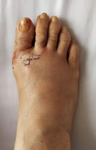 大脚骨,踇外翻畸形 - 好大夫在线