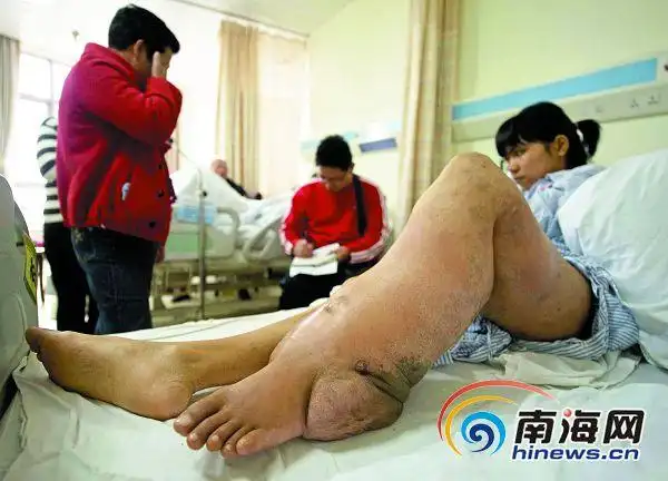 小雪的左腿如不及时手术将截肢 南国都市报记者 刘孙谋摄