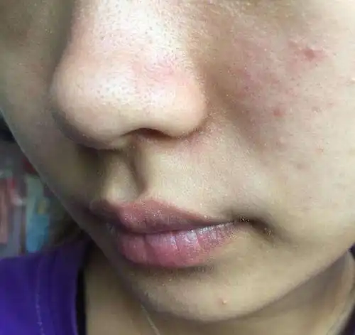 25周岁,混合型皮肤,肤色偏黄,有毛孔,黑头.其他没什么问题.