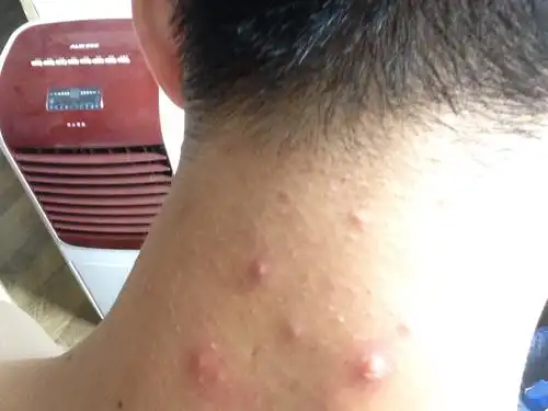 有时候会痒 不疼,是淋巴发炎吗,有说是毛囊发炎,具体是什么啊 有了两