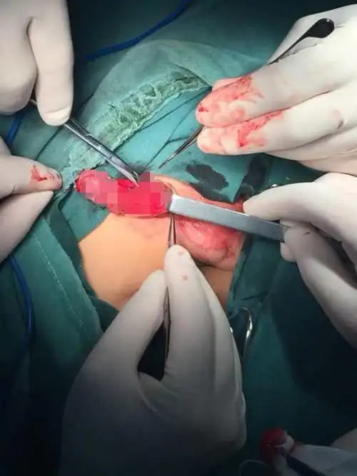 不再束缚你的自由—隐匿性阴茎矫正术