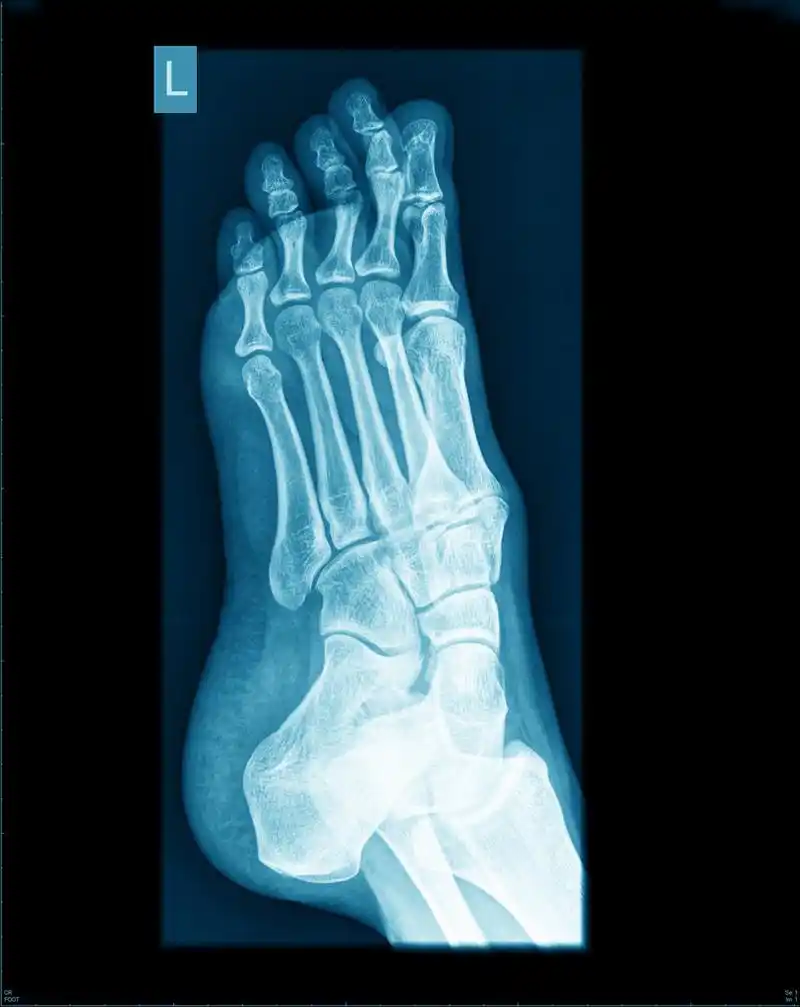 张 x 光片的脚,张 x 光片的脚